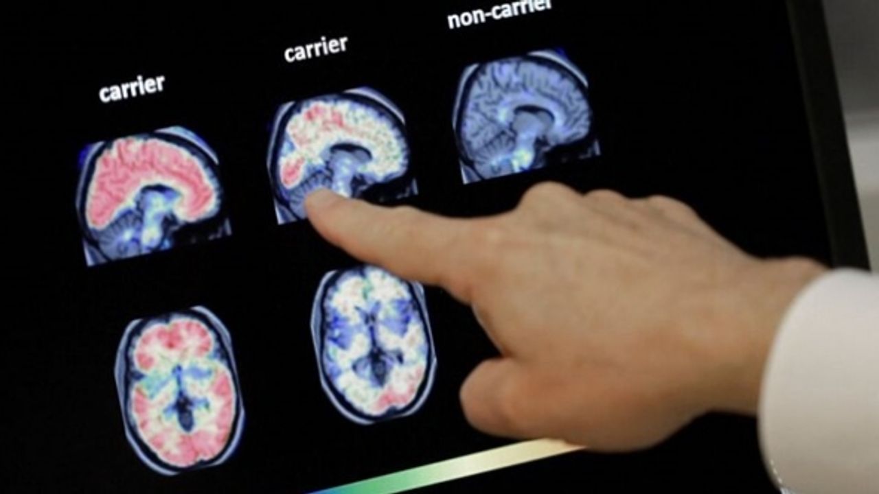 Alzheimer hastalığı için yeni geliştirilen ilaca ilk onay