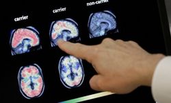 Alzheimer hastalığı için yeni geliştirilen ilaca ilk onay