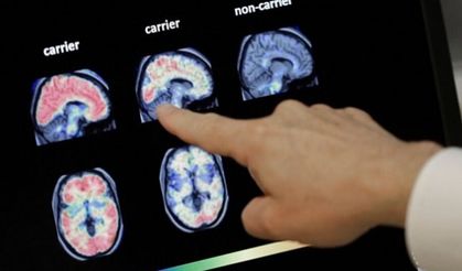 Alzheimer hastalığı için yeni geliştirilen ilaca ilk onay